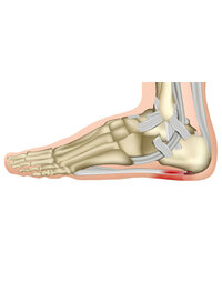 WHAT IS PLANTAR FASCIITIS?